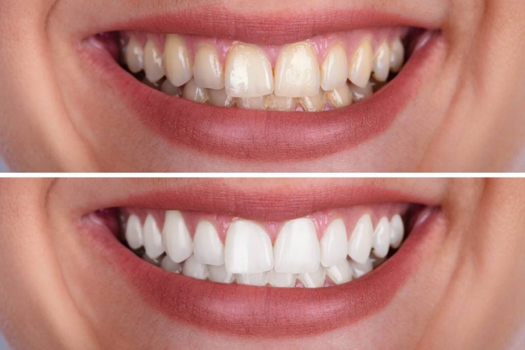 Two photos of before and after teeth whitening 1024x682 183314915