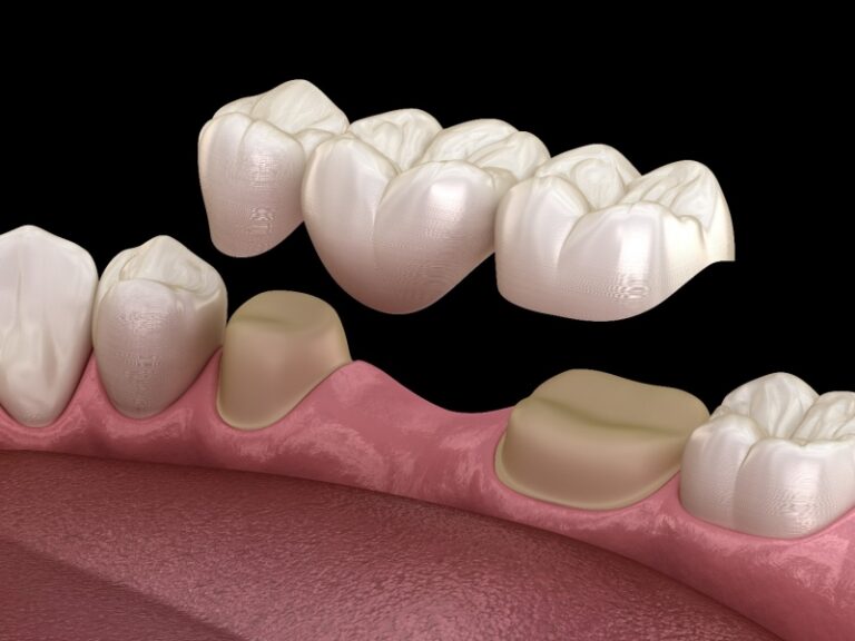 dental bridge illustration 605161661