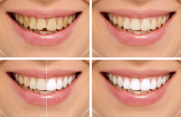 teeth whitening before and after photos 2789193181
