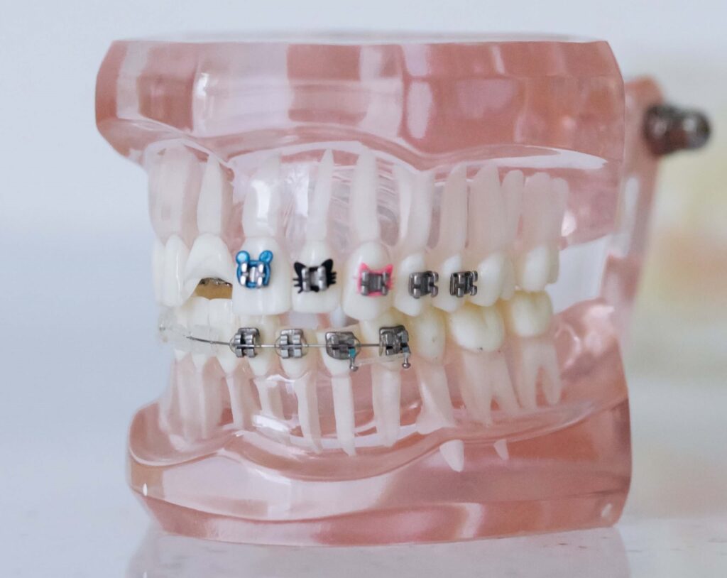 Шүдний аппарат буйл хавдах шалтгаан