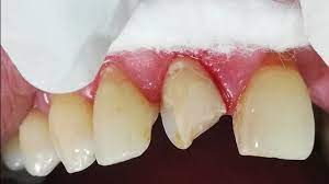 Шүдний хугарал ба мултрал