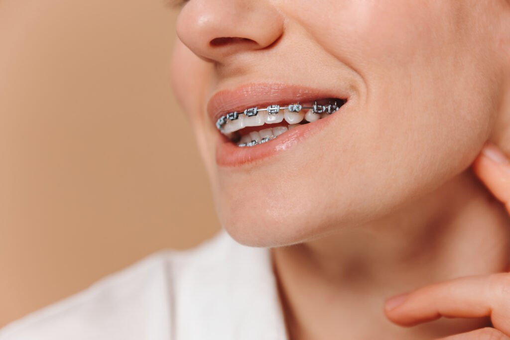 close up of a woman with braces on a beige backgro 2024 03 19 20 07 30 utc