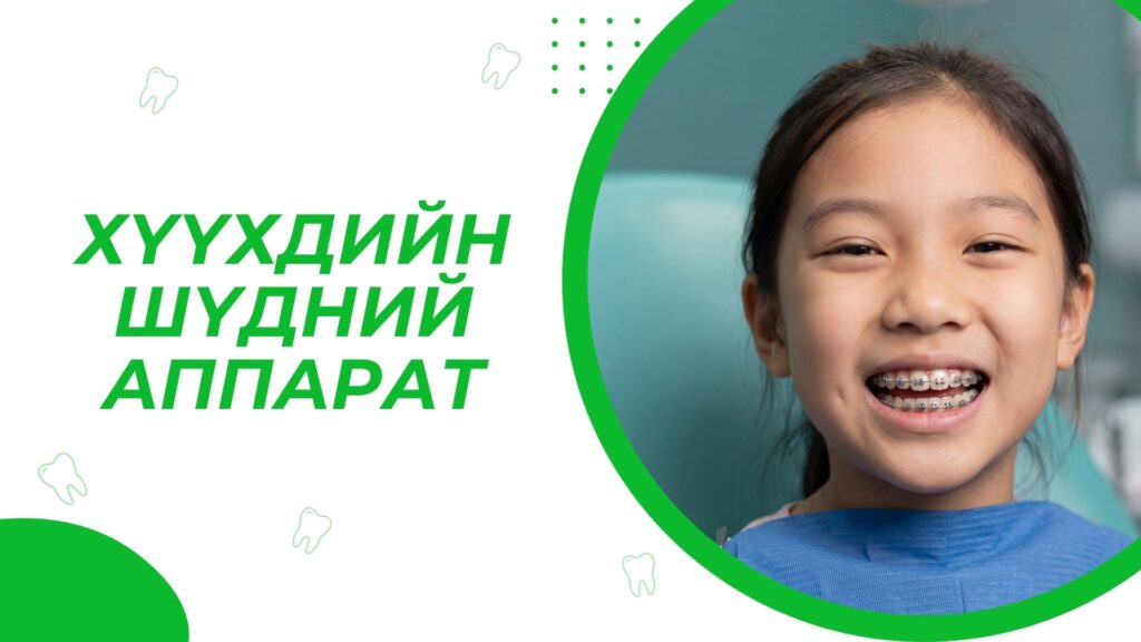 Хүүхдийн шүдний аппарат 1 Хүүхдийн шүдний аппарат