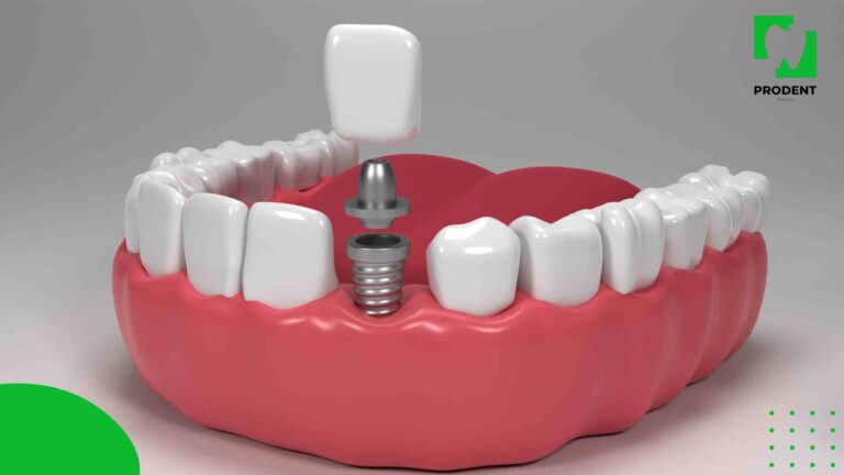 Имплант хийлгэсний дараа юуг анхаарах вэ?