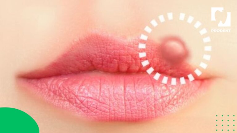 Хомхой долоох хурдан эмчлэх арга