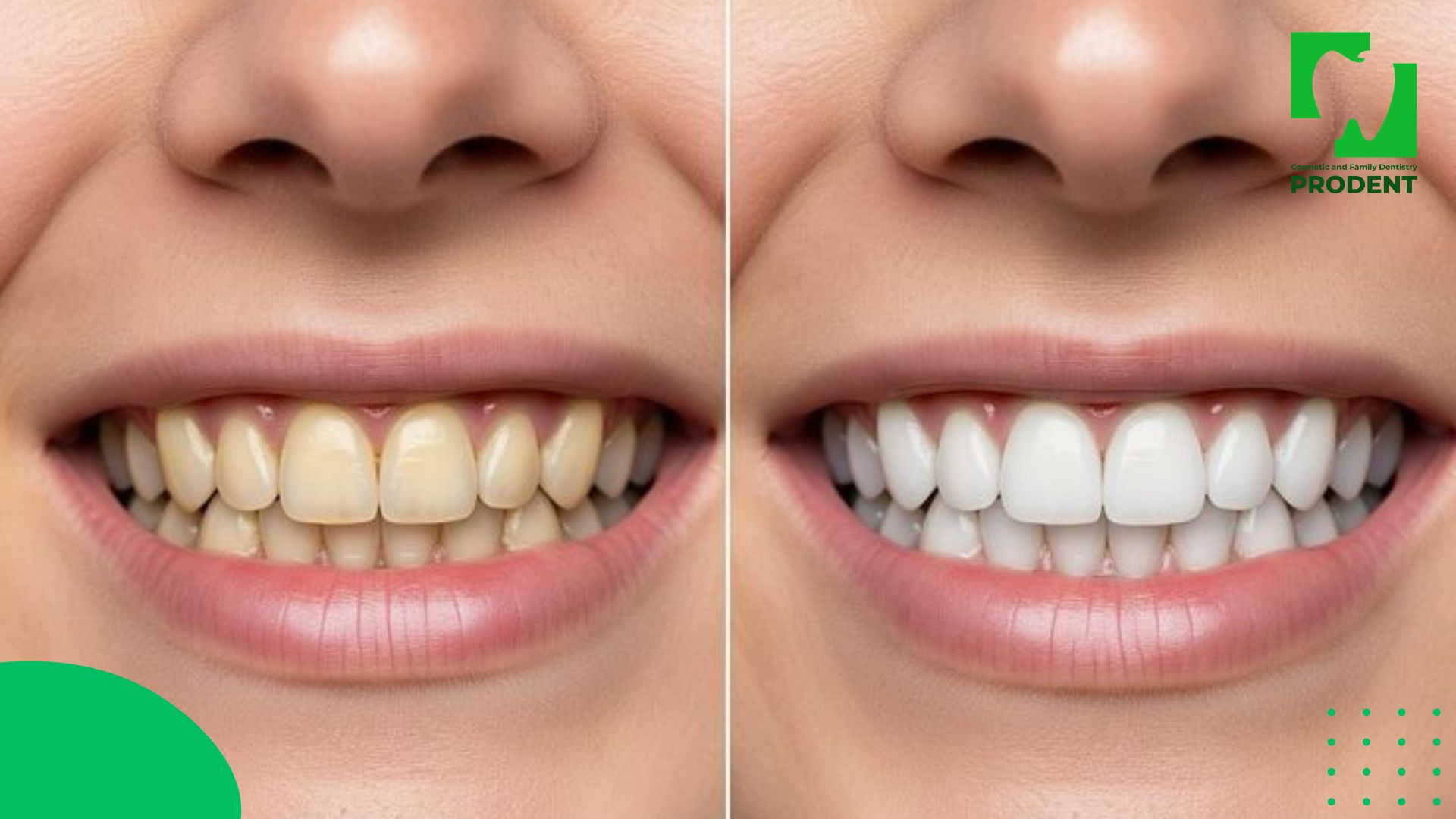 Шүдний өнгө алдсан процесс