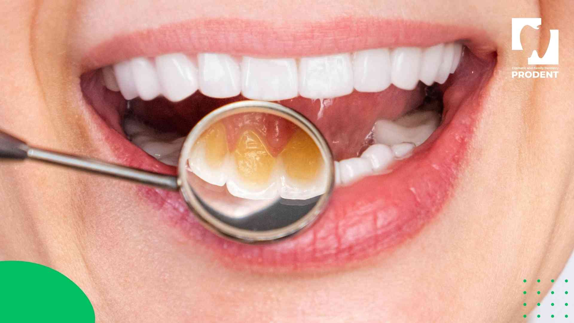 шүдний паалан хийлгэсний дараа анхаарах 7 зүйл