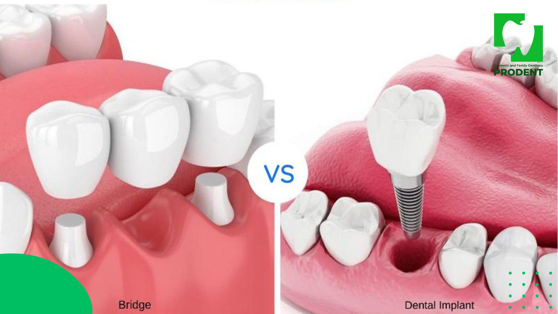 implant vs bridge overview